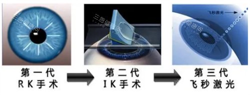 近视手术的进阶过程