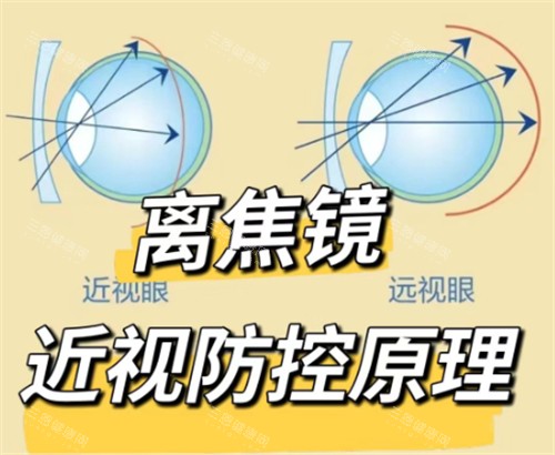 离焦镜片防控原理