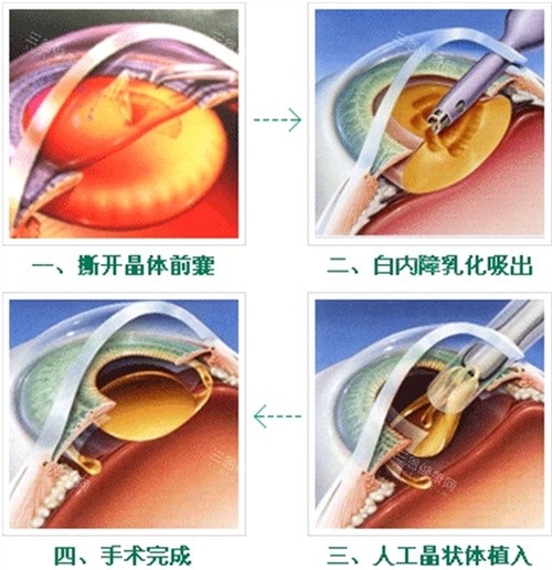 白内障手术过程图 白内障手术过程图