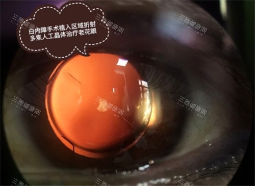 南昌做白内障免费吗？2025新政策+免费申请条件全解析！