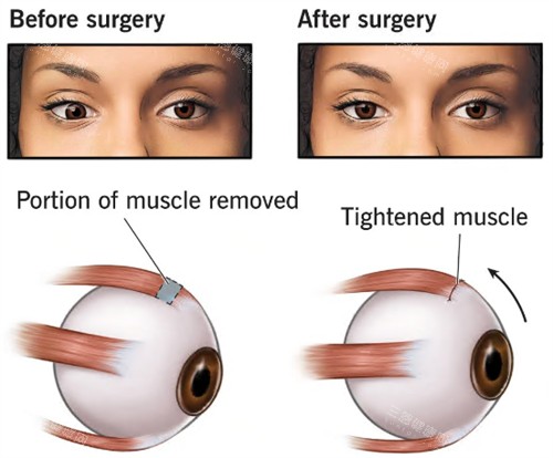 麓山地区看眼科要花多少钱？这份收费价格表帮你省心避坑！