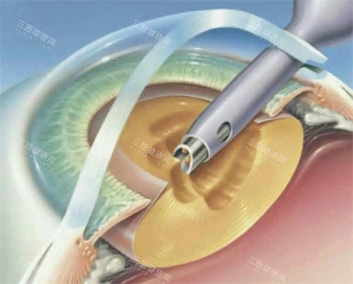 白内障超声乳化手术图片 白内障超声乳化手术图片