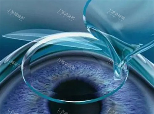 激光近视眼手术细节图 激光近视眼手术细节图