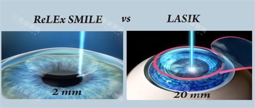 全飞秒近视手术带来的切口图解 全飞秒近视手术带来的切口图解