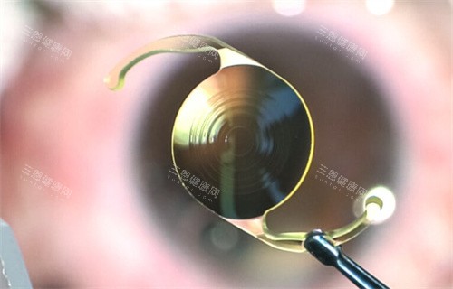 ICL人工晶体 ICL人工晶体