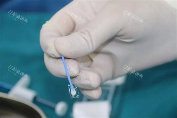 icl人工晶体真实图 icl人工晶体真实图