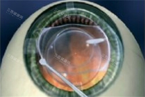 ICL晶体展开 ICL晶体展开