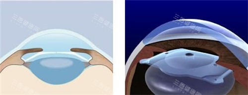 ICLV5晶体植入位置 ICLV5晶体植入位置