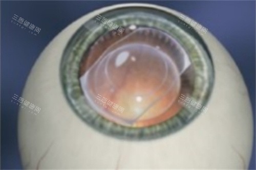 ICL晶体植入完成 ICL晶体植入完成