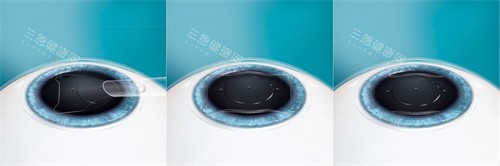 ICL晶体植入过程 ICL晶体植入过程