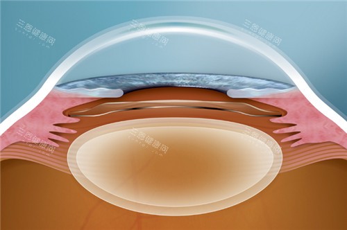 晶体植入手术动画图 晶体植入手术动画图