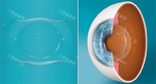 人工晶体植入眼睛的层次 人工晶体植入眼睛的层次