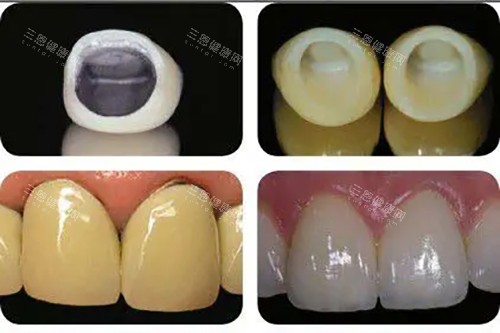 烤瓷牙冠和全瓷牙冠安装前后对比