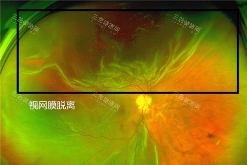 视网膜脱离照片 视网膜脱离照片