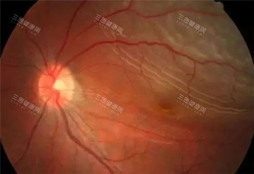 视网膜脱落照片 视网膜脱落照片