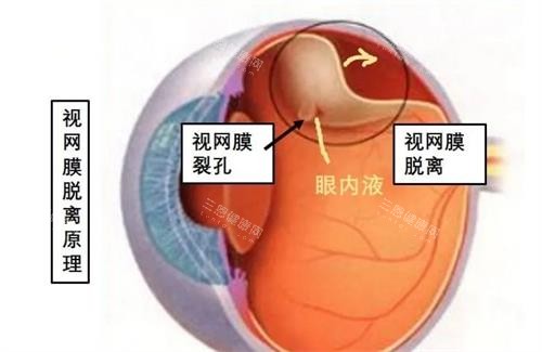 视网膜脱落原理 视网膜脱落原理