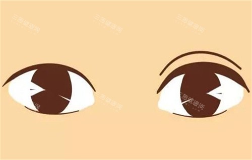 双眼皮手术的前后对比 双眼皮手术的前后对比