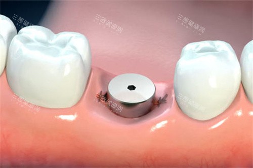 单颗种植牙愈合基台