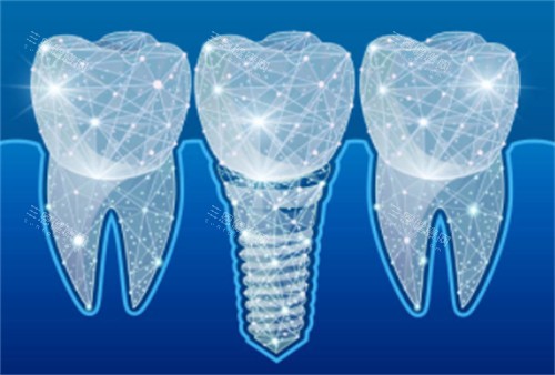 种植牙科技感卡通
