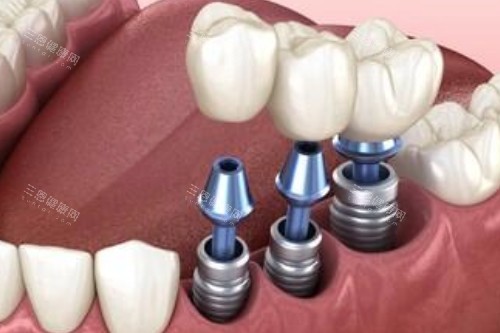 阿尔法种植体属于什么档次？与奥齿泰、诺贝尔的档次&性能对比