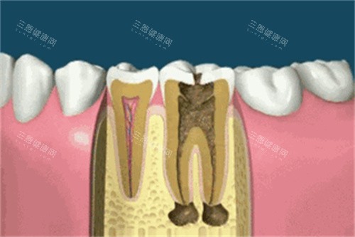 种植牙卡通展示图