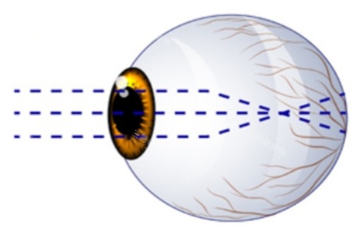 近视眼球示意图