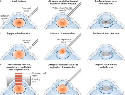 超声乳化白内障手术的流程图 超声乳化白内障手术的流程图