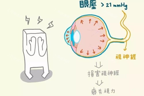 青光眼概念图片解释 青光眼概念图片解释