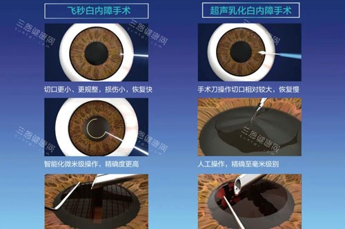 飞秒白内障和超声乳化白内障 飞秒白内障和超声乳化白内障