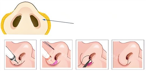 鼻翼缩小手术过程