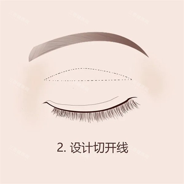 双眼皮手术