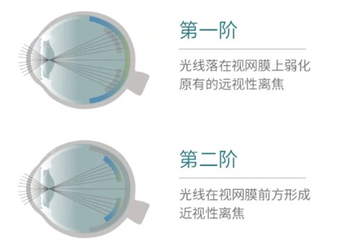 思问离焦眼镜怎么样？一篇说清它的材质、技术、结果和价格~