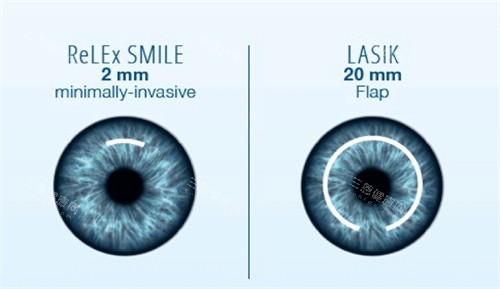 全飞秒和半飞秒手术对比图 全飞秒和半飞秒手术对比图