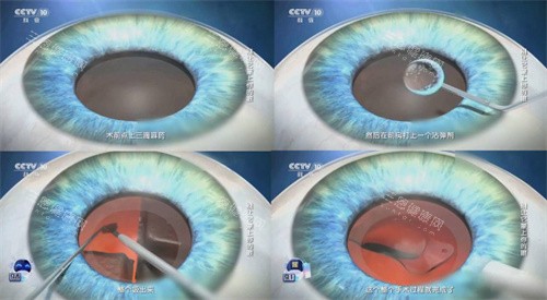 白内障手术流程简图