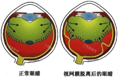 视网膜脱落卡通对比图