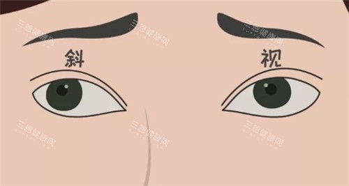 斜视眼珠表现图