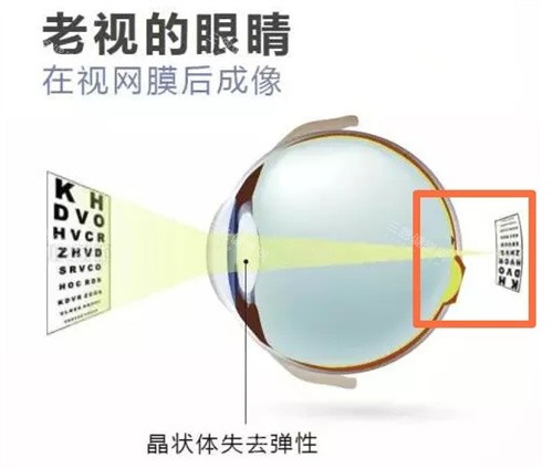 老花眼图片