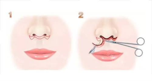 胡俊杰人中缩短价格与结果深度揭秘：人中窝3D加深技术真人实例及术后自然度长期跟踪