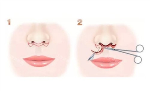 人中缩短术手术过程图解