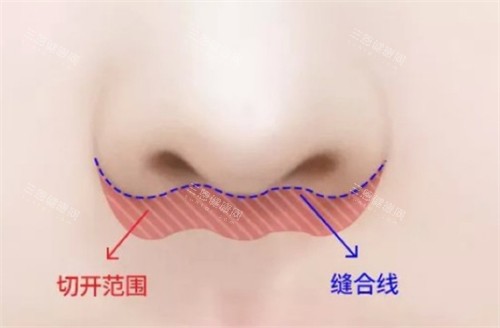 埋线人中缩短术手术位置图解