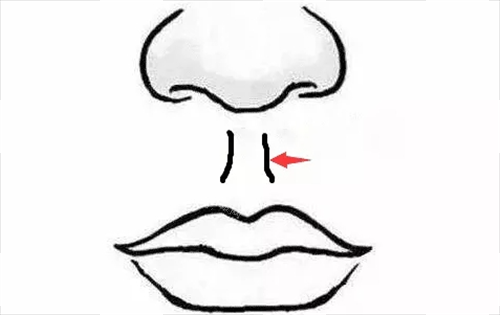 人中缩短术部位展示