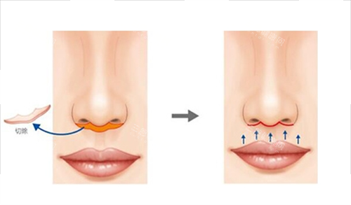 人中缩短手术切除部位